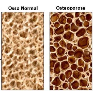 osteoporose masculina